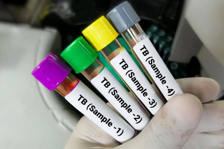 TB screening / PPD
